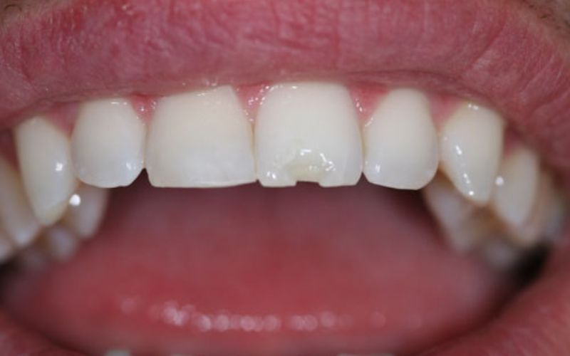 Răng sứ bị mẻ nên được thay thế sớm 